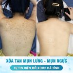 Mụn Lưng Ở Nữ Giới Do Hormone? Bí Quyết Khắc Phục Triệt Để