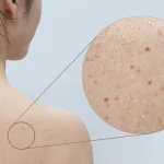 Trị Mụn Lưng Chuẩn Y Khoa – Phương Pháp Được Bác Sĩ Da Liễu Khuyên Dùng